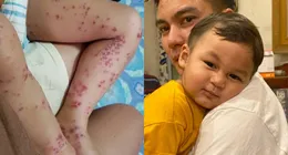 Badannya Penuh Bintik Merah, Kiano Tiger Wong Positif Flu ...
