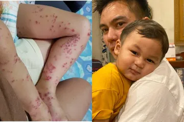 Badannya Penuh Bintik Merah, Kiano Tiger Wong Positif Flu ...