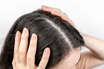 Ilustrasi rambut berketombe.