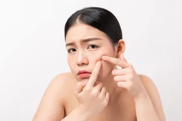 Ilustrasi jerawat.