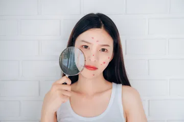 Rekomendasi acne patch