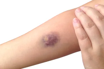 Dengarkan tubuhmu, memar tiba-tiba bisa menjadi suatu masalah kesehatan
