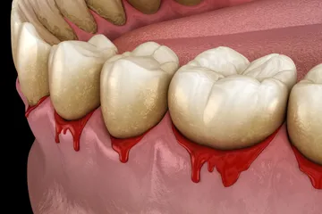 Peiodontitis