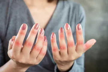 Fakta penyakit lupus