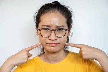 Mengatasi jerawat hormonal.