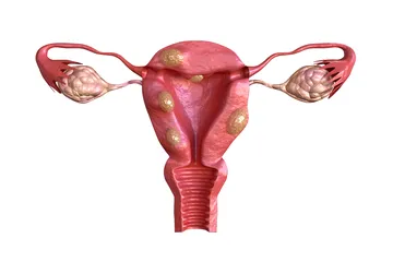 Penyebab fibroid rahim yang banyak dialami perempuan.