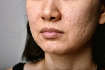 Jenis perawatan untuk mengatasi wajah bopeng.