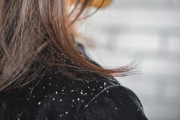 Beberapa kesalahan merawat rambut berketombe yang viral di TikTok