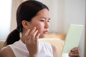 Perempuan bisa pakai skincare routine ini untuk hilangkan bekas jerawat