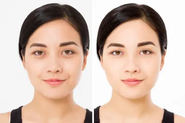 Mengenal prosedur operasi Lower Blepharoplasty untuk hilangkan kantung mata.