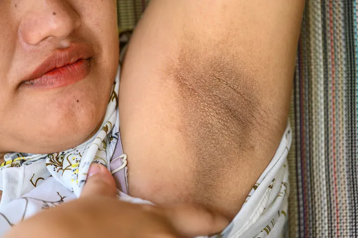 Penyebab ketiak menghitam