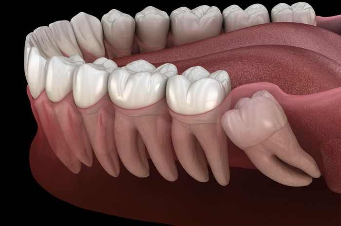 Kapan Gigi Bungsu Tumbuh Ketahui Ini Gejala Kemunculannya Parapuan