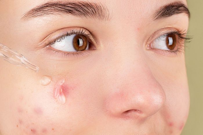 Efektif Atasi Jerawat, Ini 5 Kandungan Terbaik dalam Acne Spot