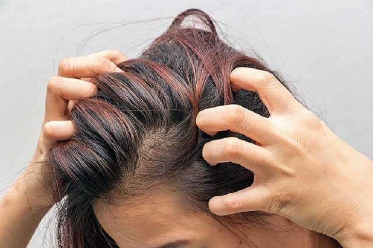 Kulit kepala dapat mengalami kering. Jika kamu mengalami hal ini, ini dia 5 cara yang dapat kamu lakukan agar kulit kepala lembab kembali. 