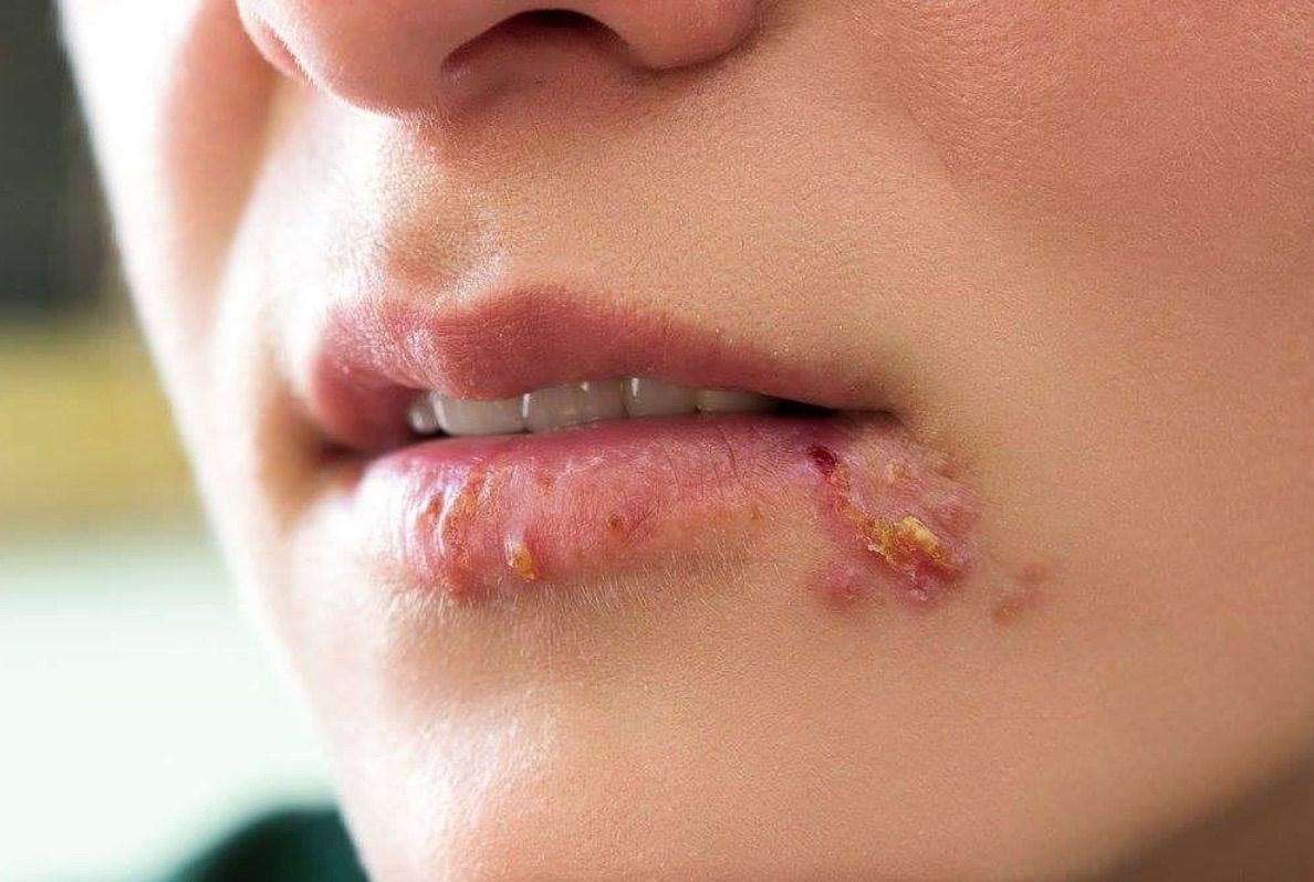 Jerawat di bibir atau cold sore menjadi hal yang mengganggu. Namun jenis jerawat ini berbeda dengan jerawat di kulit umumnya. Simak ulasannya 