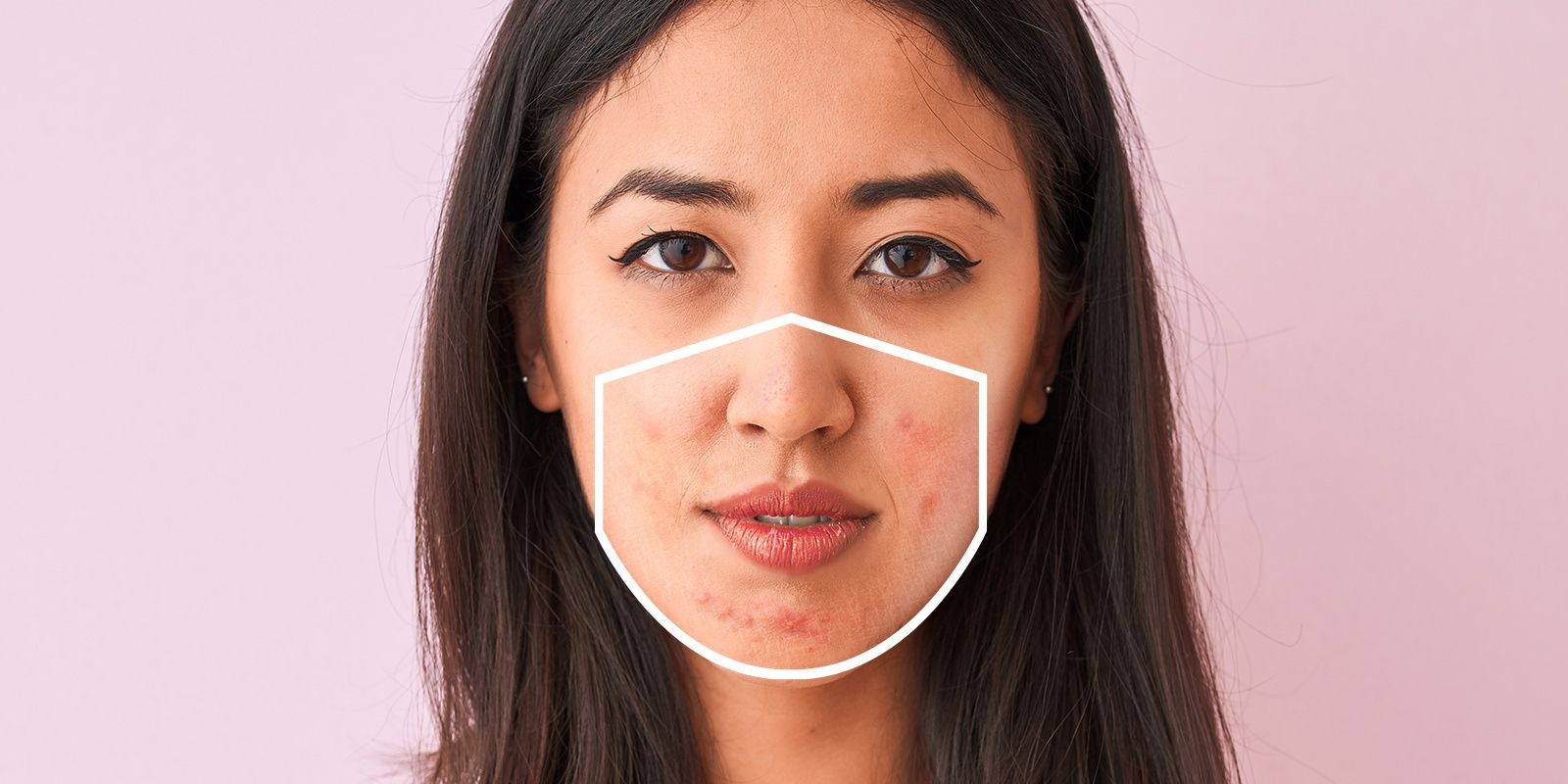 Memakai masker selama pandemi Covid-19 bisa menyebabkan munculnya mask acne (maskne). Ini rekomendasi facial wash untuk mengatasi maskne.