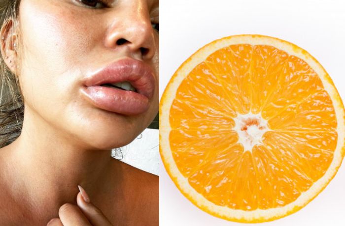 Lewat akun Instagram pribadinya, Chrissy Teigen menunjukkan bibirnya yang membengkak. Wah kenapa ya?