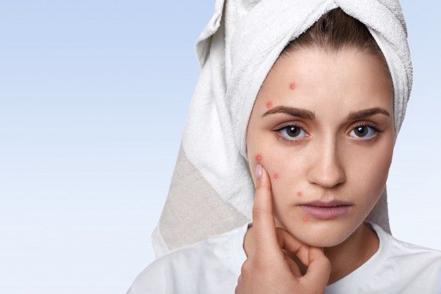 Selain pemilihan produk skincare, kamu juga harus memperhatikan jenis makanan yang masuk ke dalam tubuh jika ingin terhindar dari jerawat. 