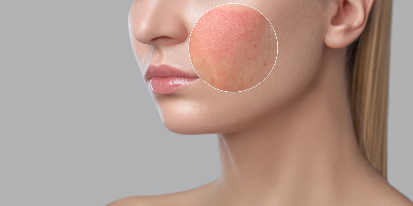 Bagi pengidap penyakit kulit rosacea, kulit yang kemerahan dan berbintik bisa jadi kondisi permanen yang cukup mengkhawatirkan. Berikut penjelasannya.