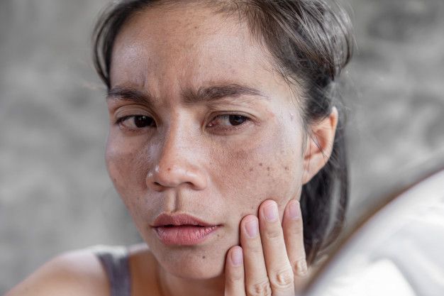 Hiperpigmentasi di wajah umumnya terjadi akibat paparan sinar UV. Selain itu, hiperpigmentasi atau flek hitam juga disebabkan oleh hal-hal berikut.