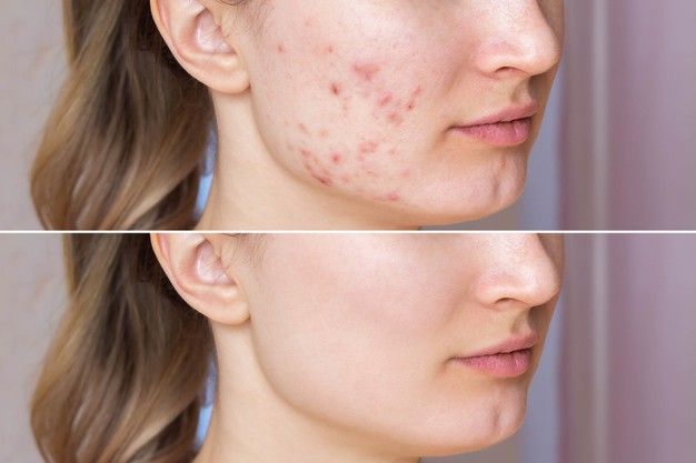 Jerawat juga berpotensi muncul di kulit kering juga lo, Kawan Puan. Yuk, ketahui cara mencegah dan mengobati jerawat di kulit kering!