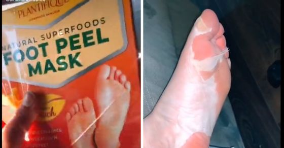 Apakah aman melakukan pengelupasan kulit kaki menggunakan foot peel mask seperti yang viral di TikTok? Begini jawaban ahli dermatologi. 