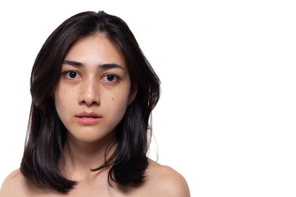Memasuki masa remaja bisa menjadi begitu menantang. Salah satu hal yang menantang adalah mengalami masalah kulit yang muncul di usia remaja. Apa saja?