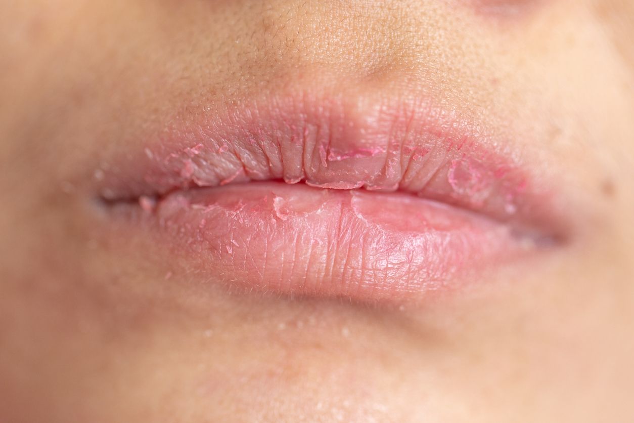 Kawan Puan masih sering mencabut kulit bibir? Jika iya, sebaiknya tidak lakukan karena ada 4 bahaya yang mengintai!