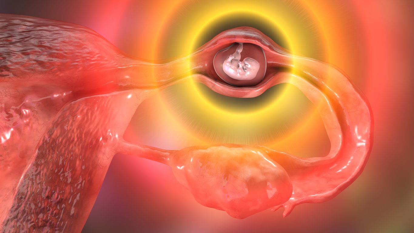 Salpingektomi atau prosedur bedah pengangkatan tuba fallopi bisa berpotensi menjadi penyebab menopause dini. Tapi, apakah masih bisa hamil?