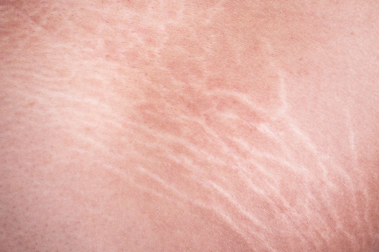 Ini 6 penyebab munculnya stretch mark di payudara, mulai dari karena perubahan hormonal hingga keturunan. Lantas, bisakah dicegah?