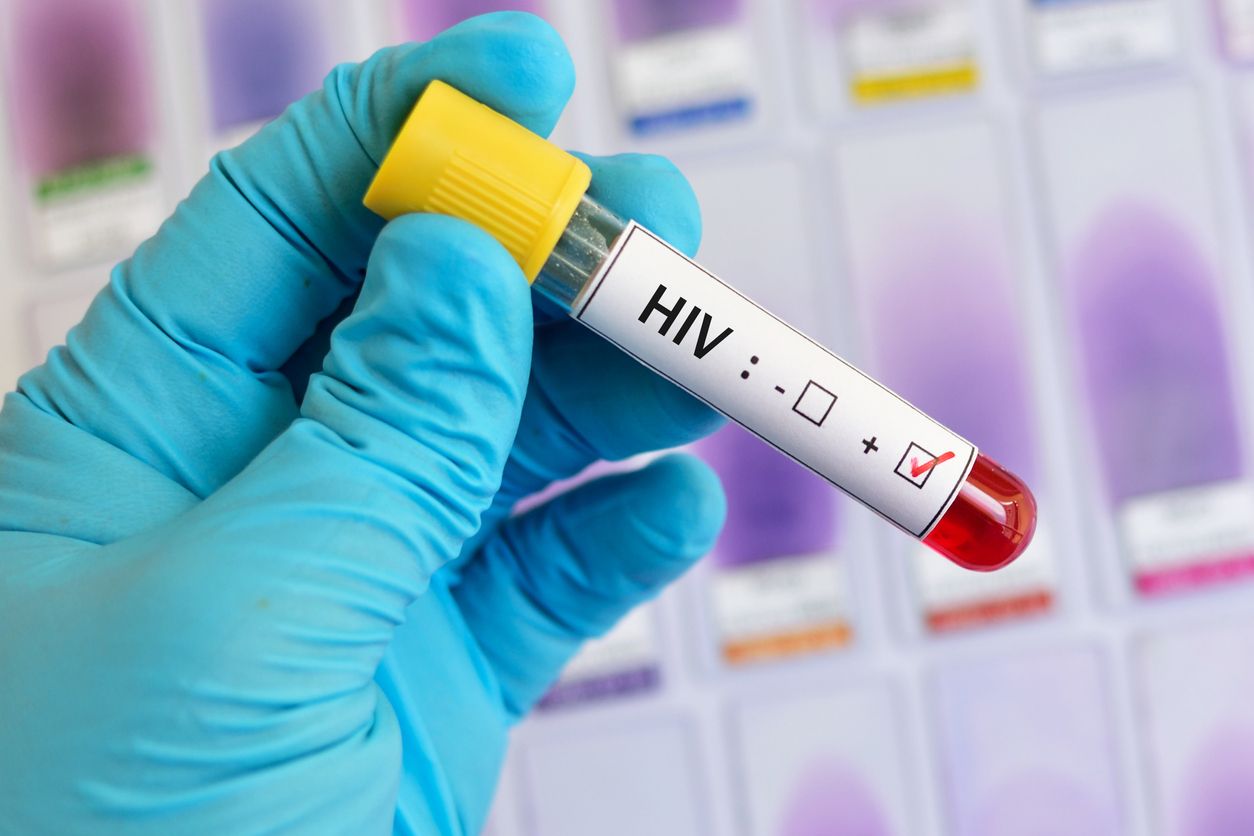 Menyambut Hari AIDS Sedunia 2021, pentingnya mengetahui gejala awal infeksi HIV sampai menjadi penyakit AIDS. Simak, inilah tahapannya!