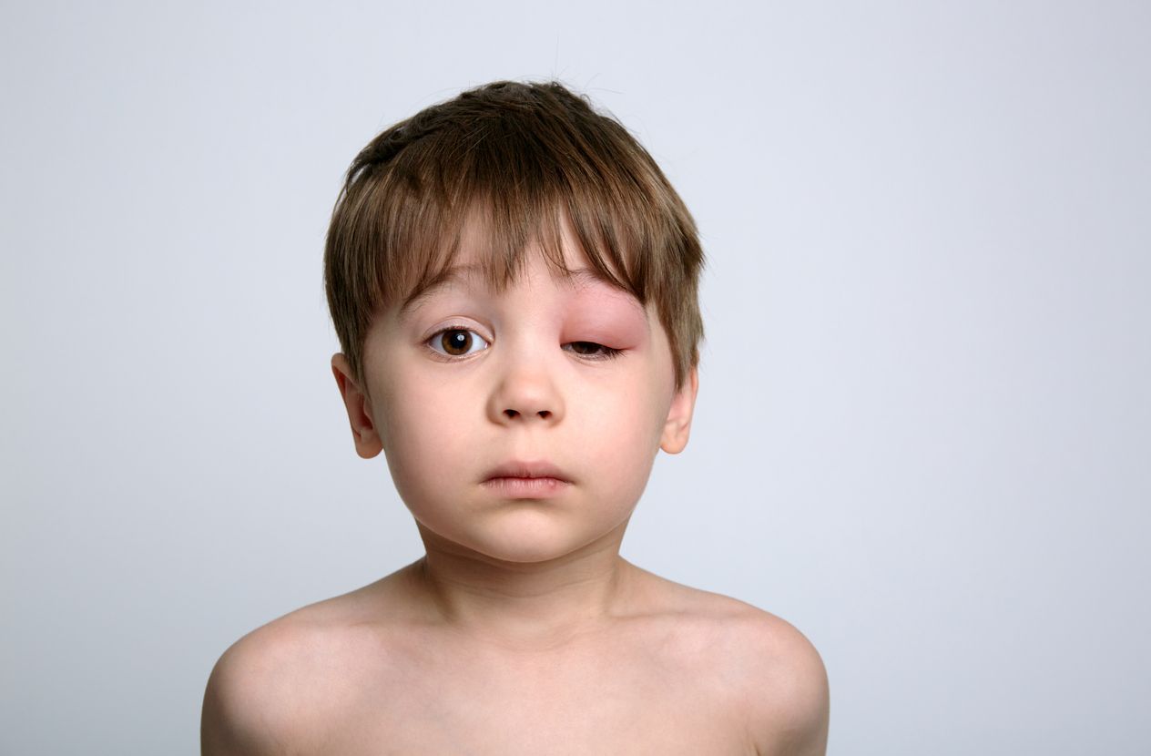 Angioedema adalah pembengkakan di bawah kulit akibat reaksi alergi. Simak, berikut ini penyebab, pemicu, dan gejala angioedema.