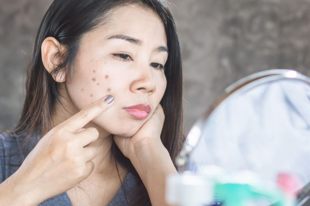 Penyebab bintik hitam di kulit wajah yang perlu diketahui. Salah satunya kebiasaan tak memakai sunscreen secara rutin!
