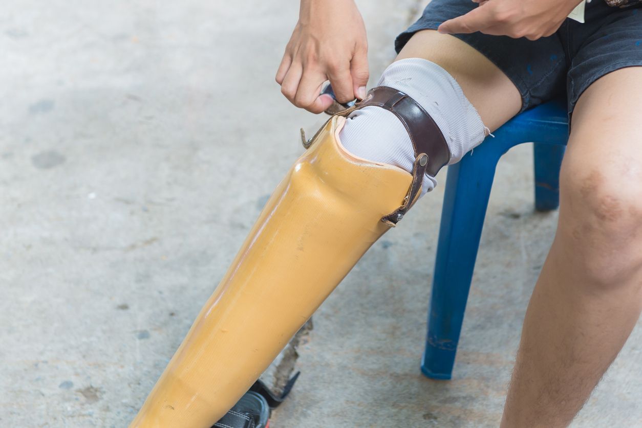 Diabetes yang tidak terkontrol kerap dikaitkan dengan amputasi kaki. Mengapa demikian? Yuk, cari tahu penjelasannya!