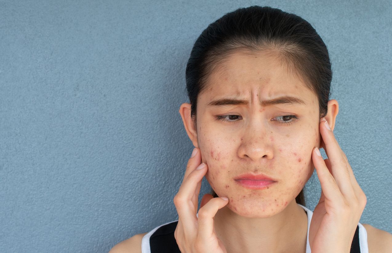 Ini dia rahasia merawat kulit bopeng agar kembali mulus menurut  skincare viral di TikTok. Sudah tahu?