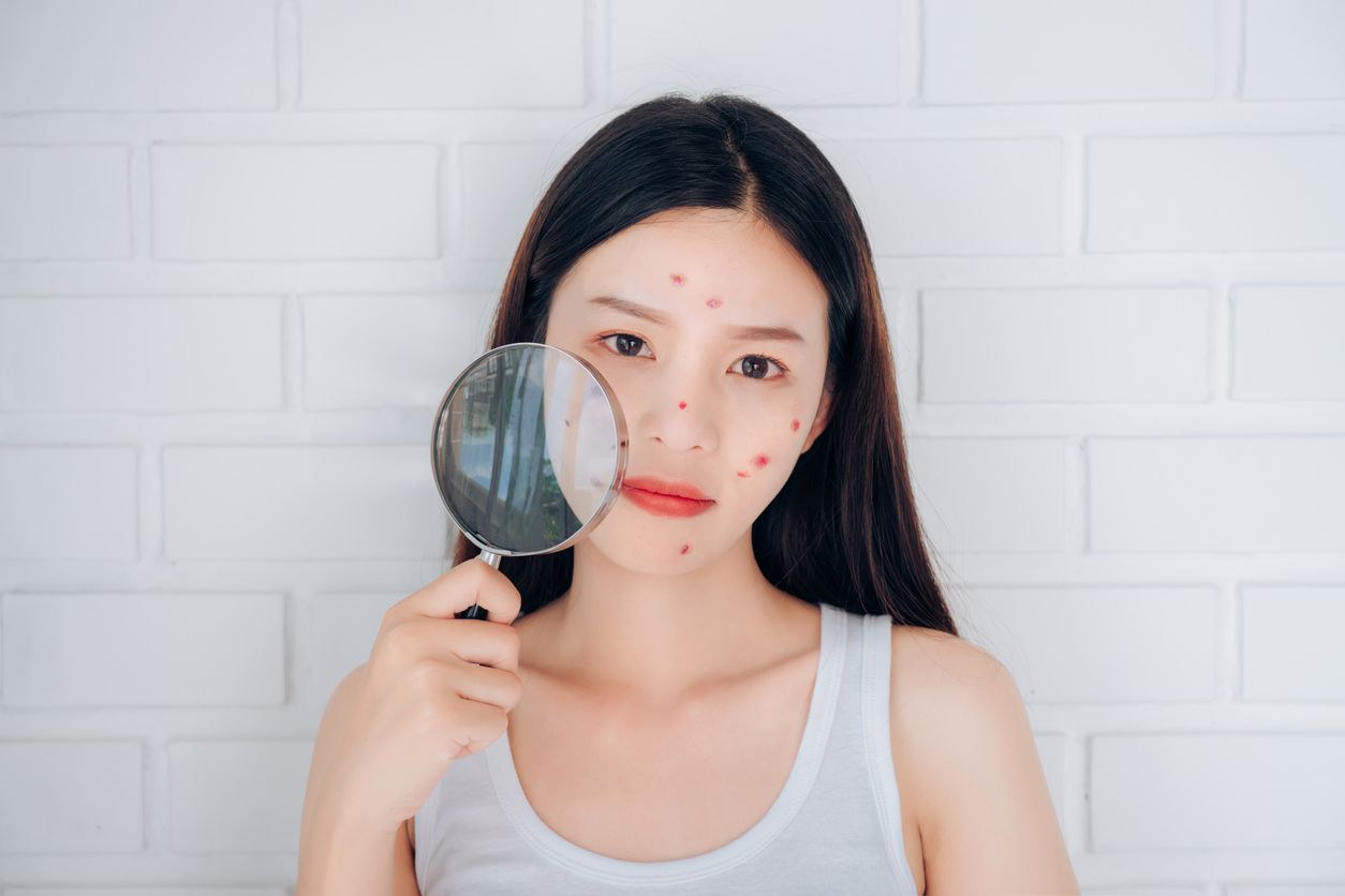 Kerap tak disadari, sejumlah kebiasaan memakai skincare berikut ini ternyata bisa memperparah kondisi jerawat. Apa saja?