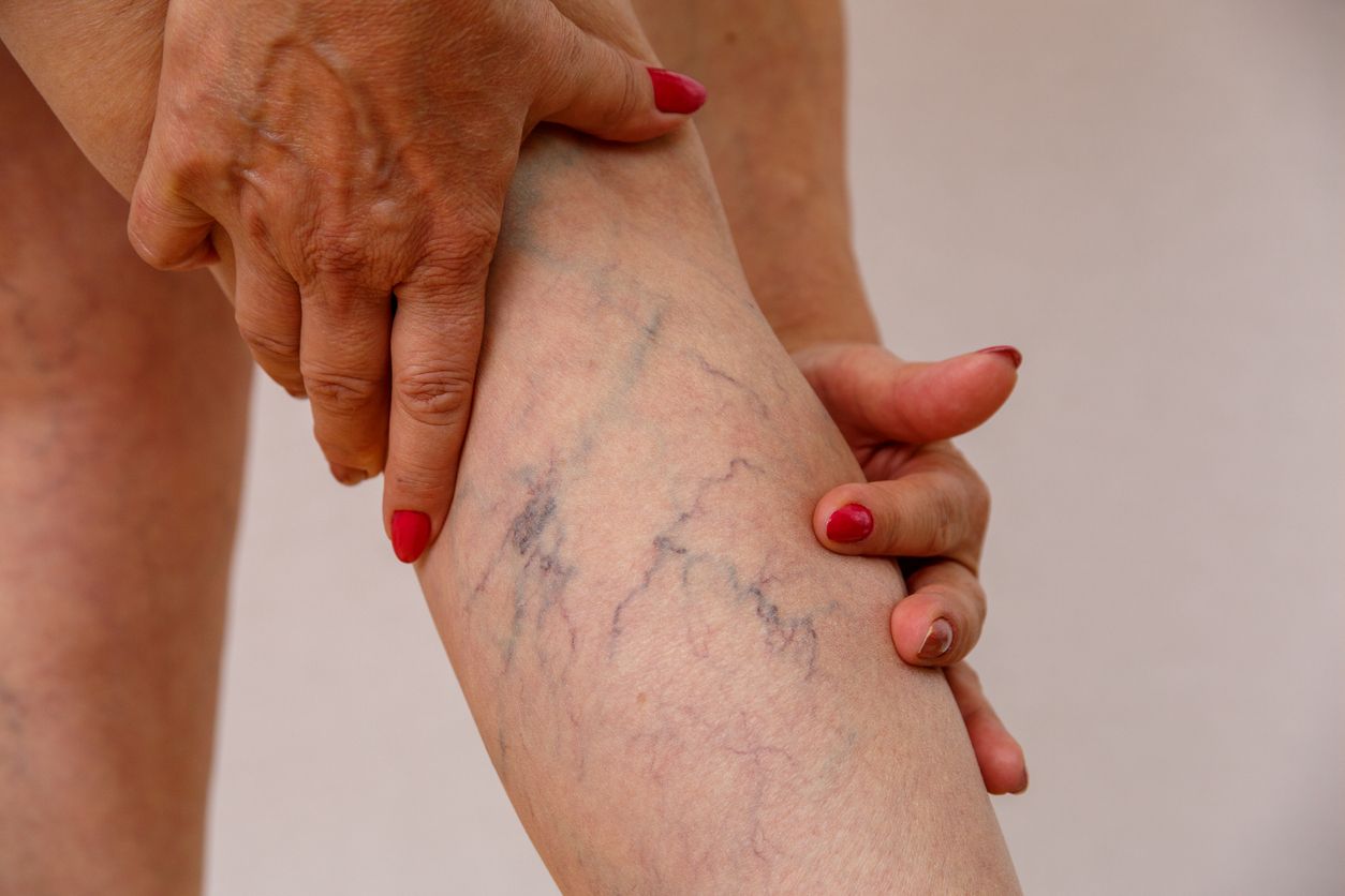 Ada mitos bahwa menekuk kaki setelah olahraga bisa menyebabkan varises, apakah benar? Simak penjelasan ahli dermatologi berikut!