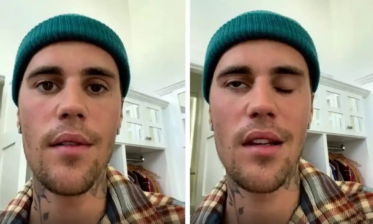 Justin Bieber tunda beberapa konser lantaran perlu istirahat menderita kelumpuhan wajah. Simak, berikut gejalanya.