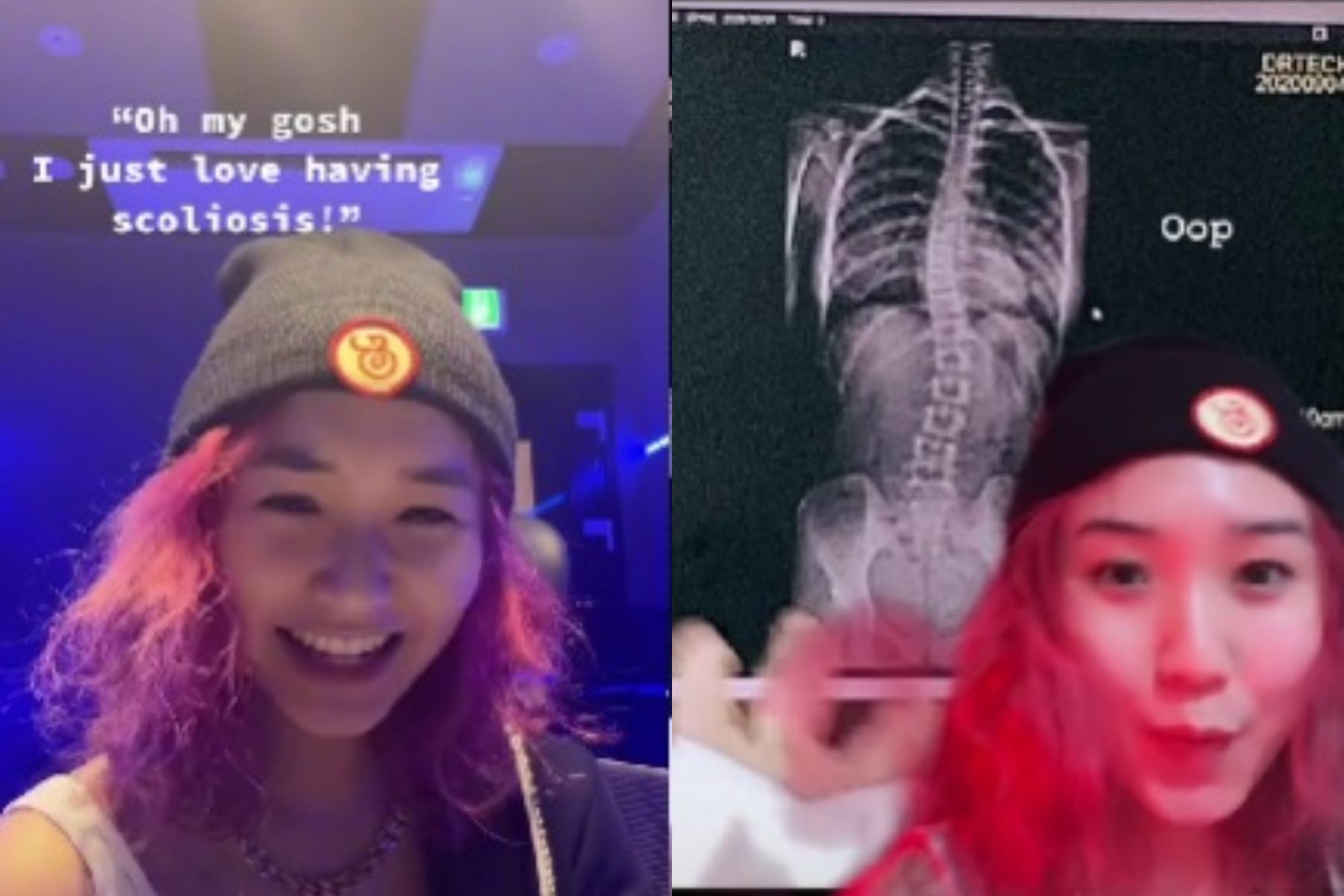 Denise mantan SECRET NUMBER mengidap skoliosis, kenali penyebab dan gejala yang terjadi pada orang dewasa.