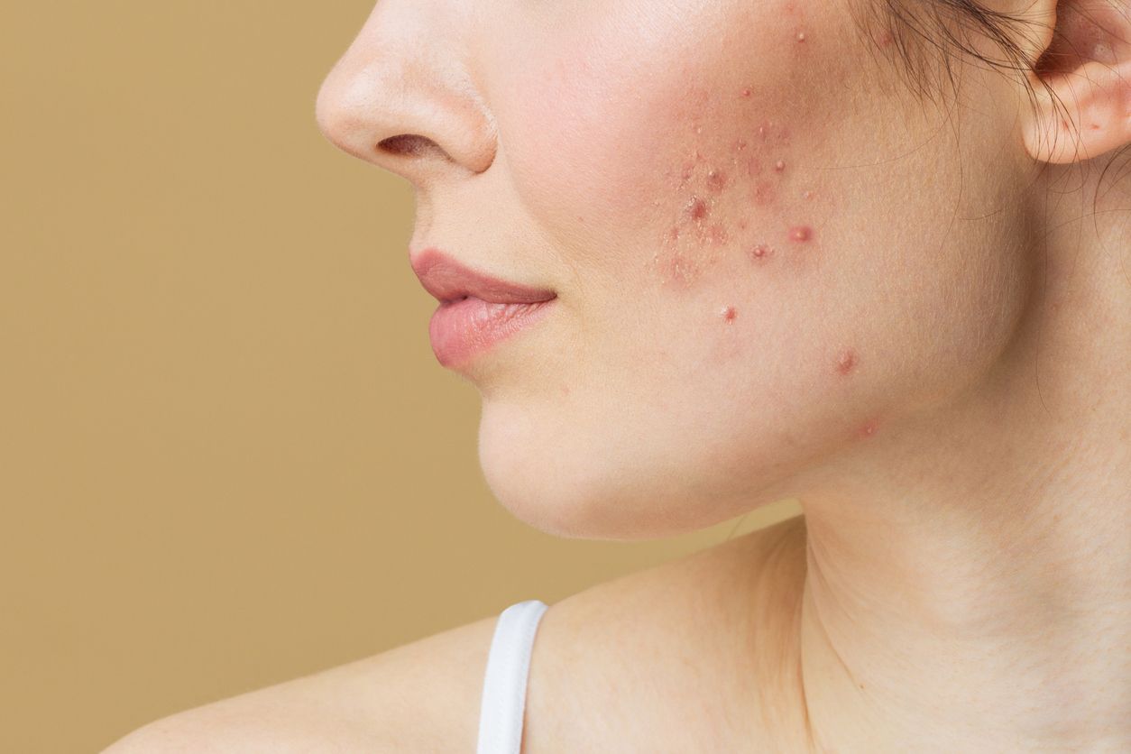 Dalam rangka promo belanja 9.9, berikut rekomendasi skincare lokal untuk kulit berjerawat.  Simak penjelasannya!