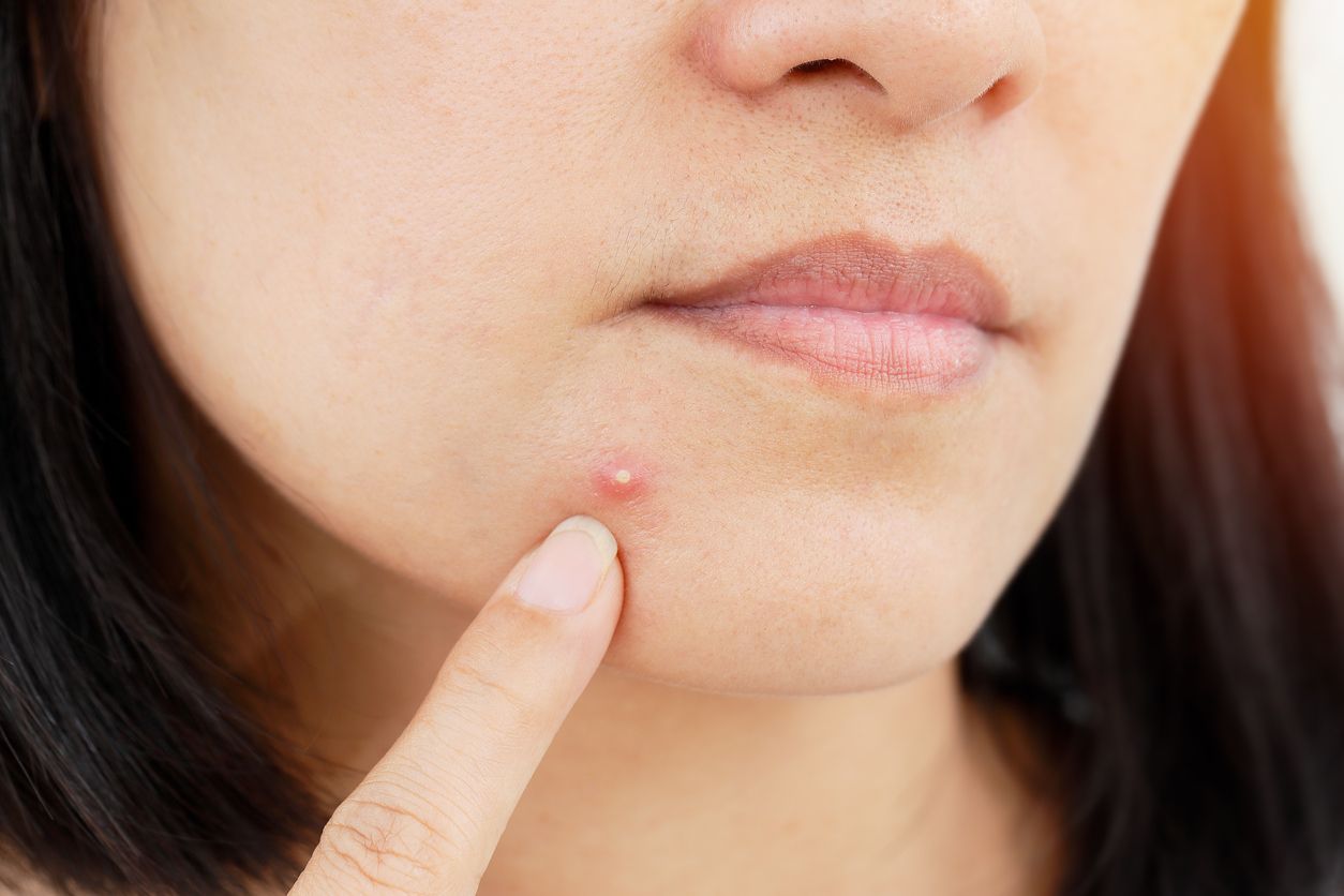 Jerawat hormonal disebabkan oleh perubahan hormon seseorang. Ini dia ciri jerawat hormonal yang perlu diketahui.