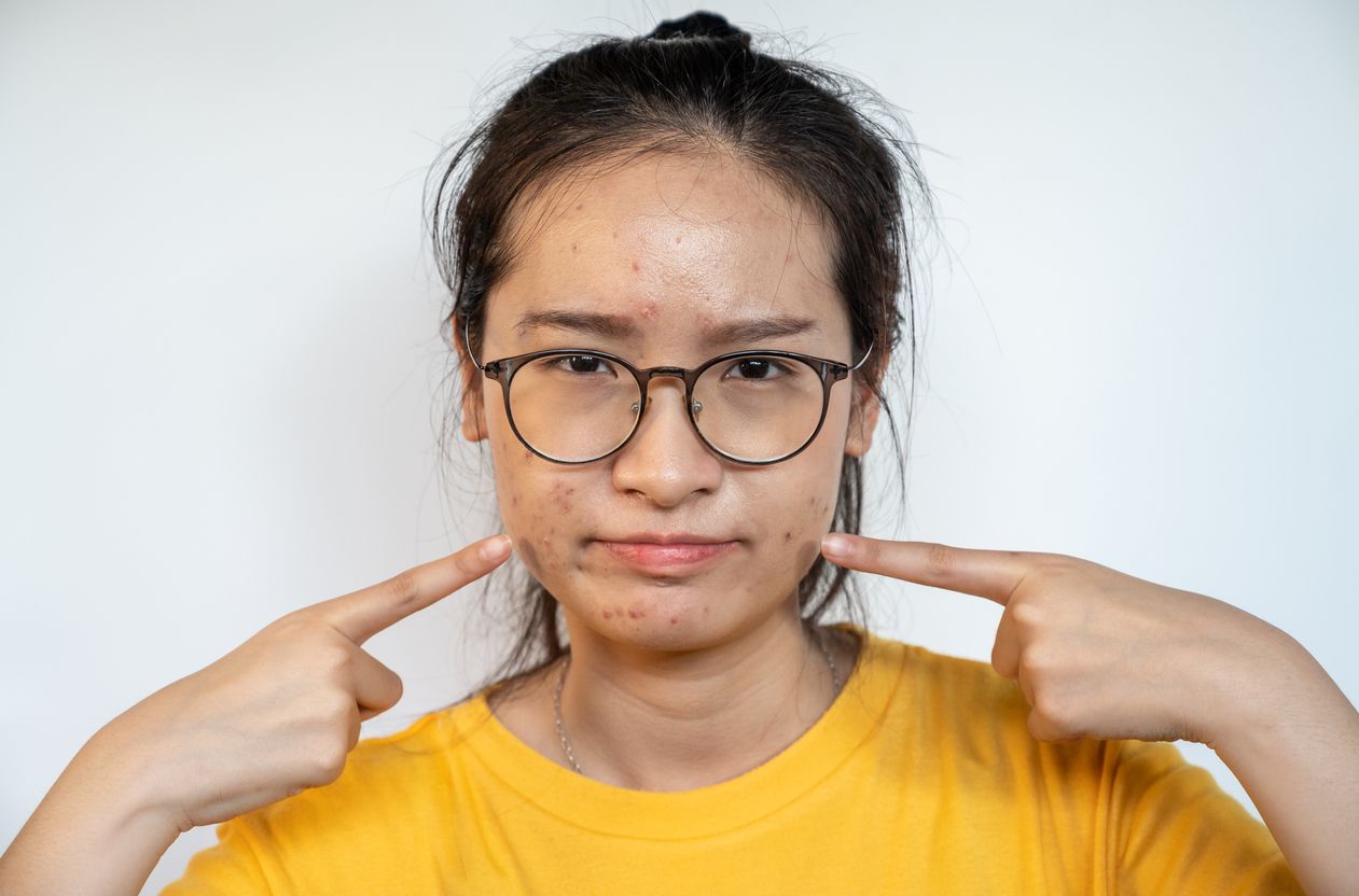 Jerawat hormonal biasanya terjadi menjelang menstruasi. Lantas, bagaimana cara mengatasi jerawat hormonal ini?