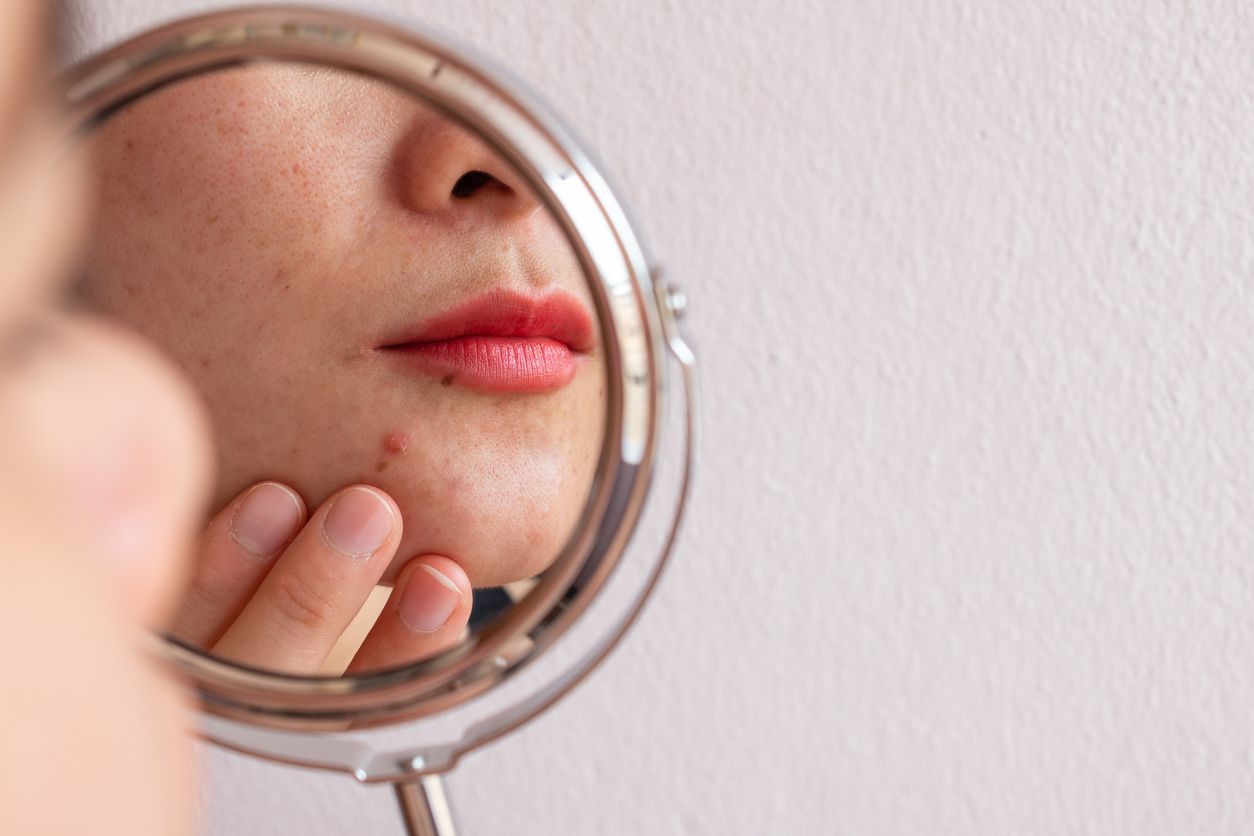 Beruntusan bikin kamu tak percaya diri? Jangan khawatir, lima produk skincare ini bisa membantu mengatasi beruntusan.