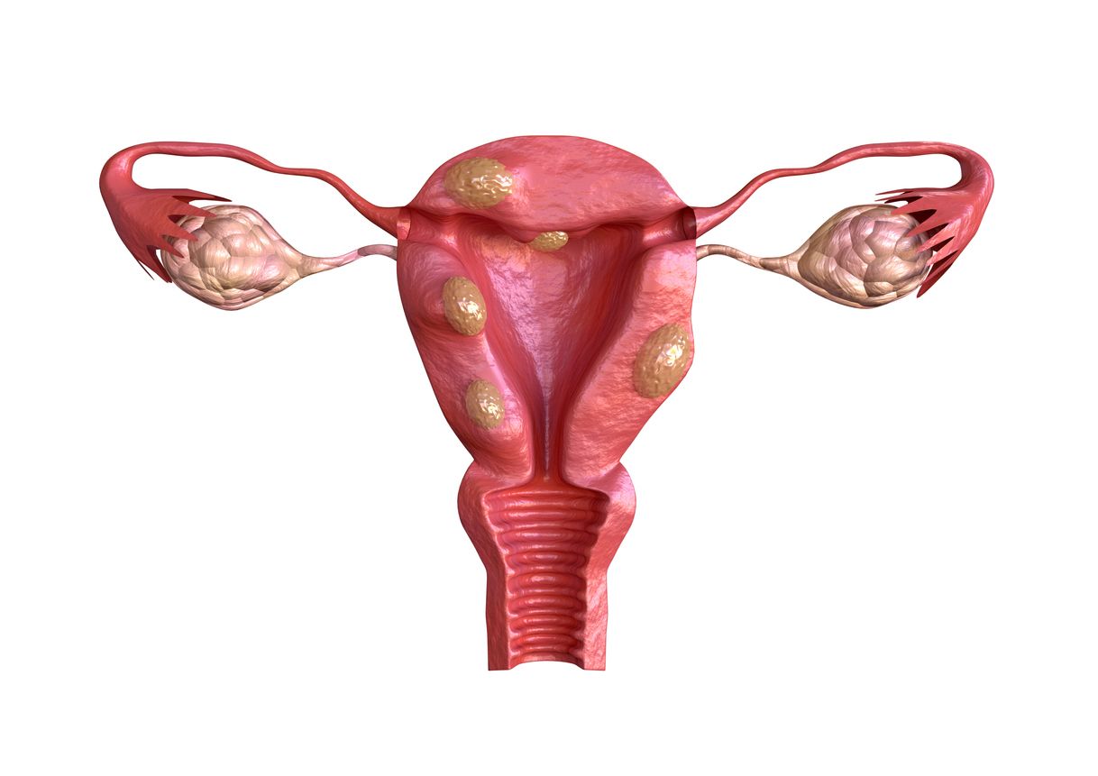 Berikut ini penyebab fibroid rahim yang harus diketahui oleh Kawan Puan, ada genetik hingga pertumbuhan matriks ektraseluler.