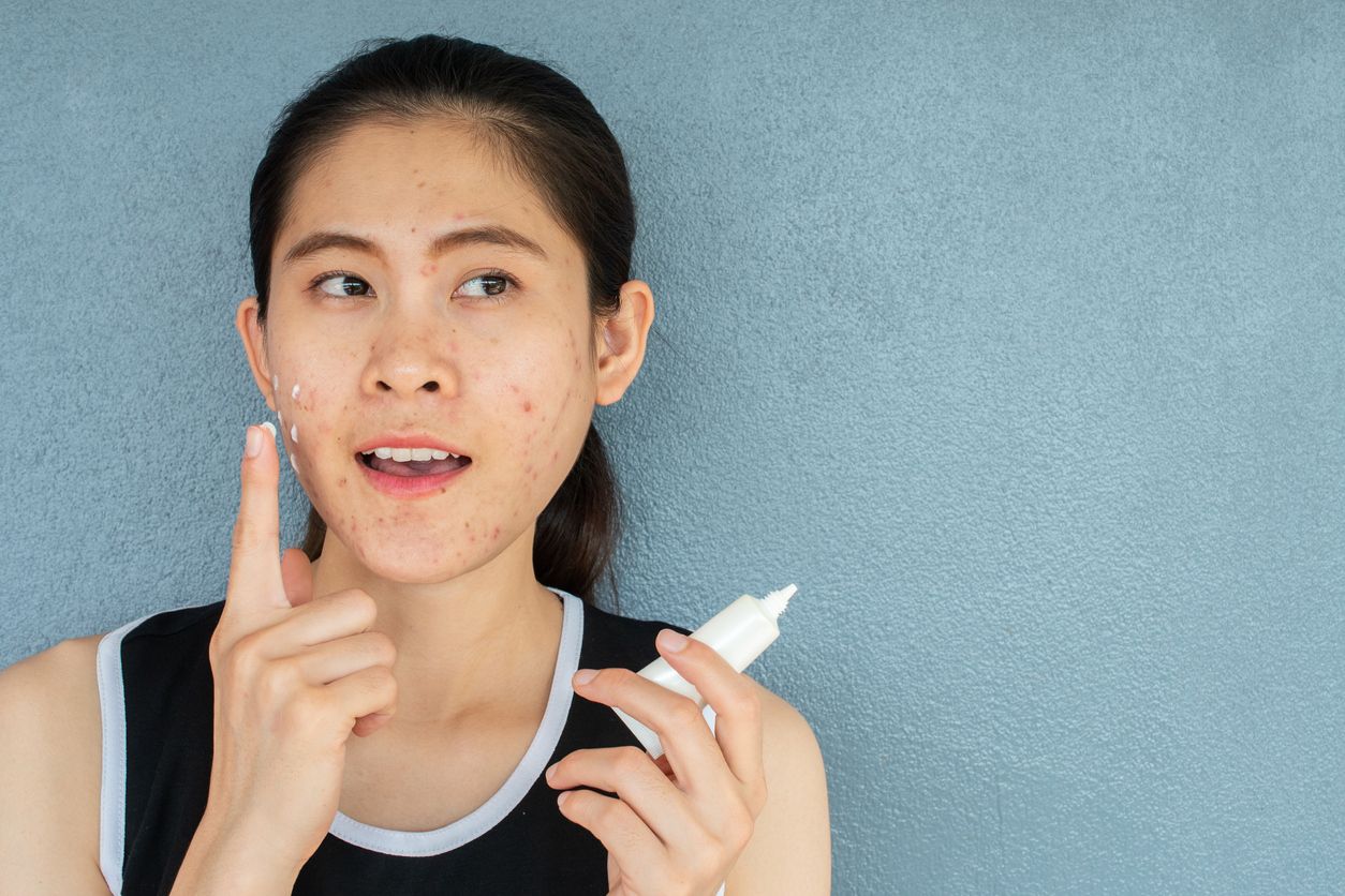 Ini lima rekomendasi acne spot treatment dari brand lokal dengan harga terjangkau yang bisa membantu menghempaskan jerawat.