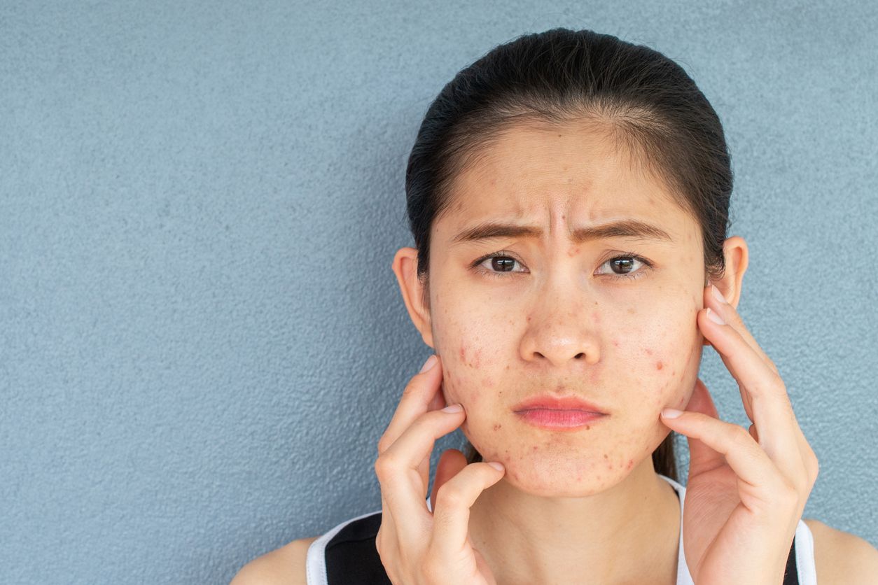 Kerap mengganggu penampilan, kenali beberapa faktor yang menyebabkan timbulnya jerawat di alis. Mulai dari T-zone berminyak hingga produk hair care.