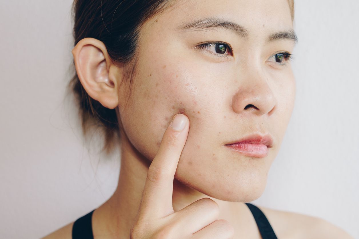 Bekas jerawat PIH menjadi masalah kulit yang membandel untuk dipudarkan. Berikut kandungan skincare yang ampuh mengatasinya!