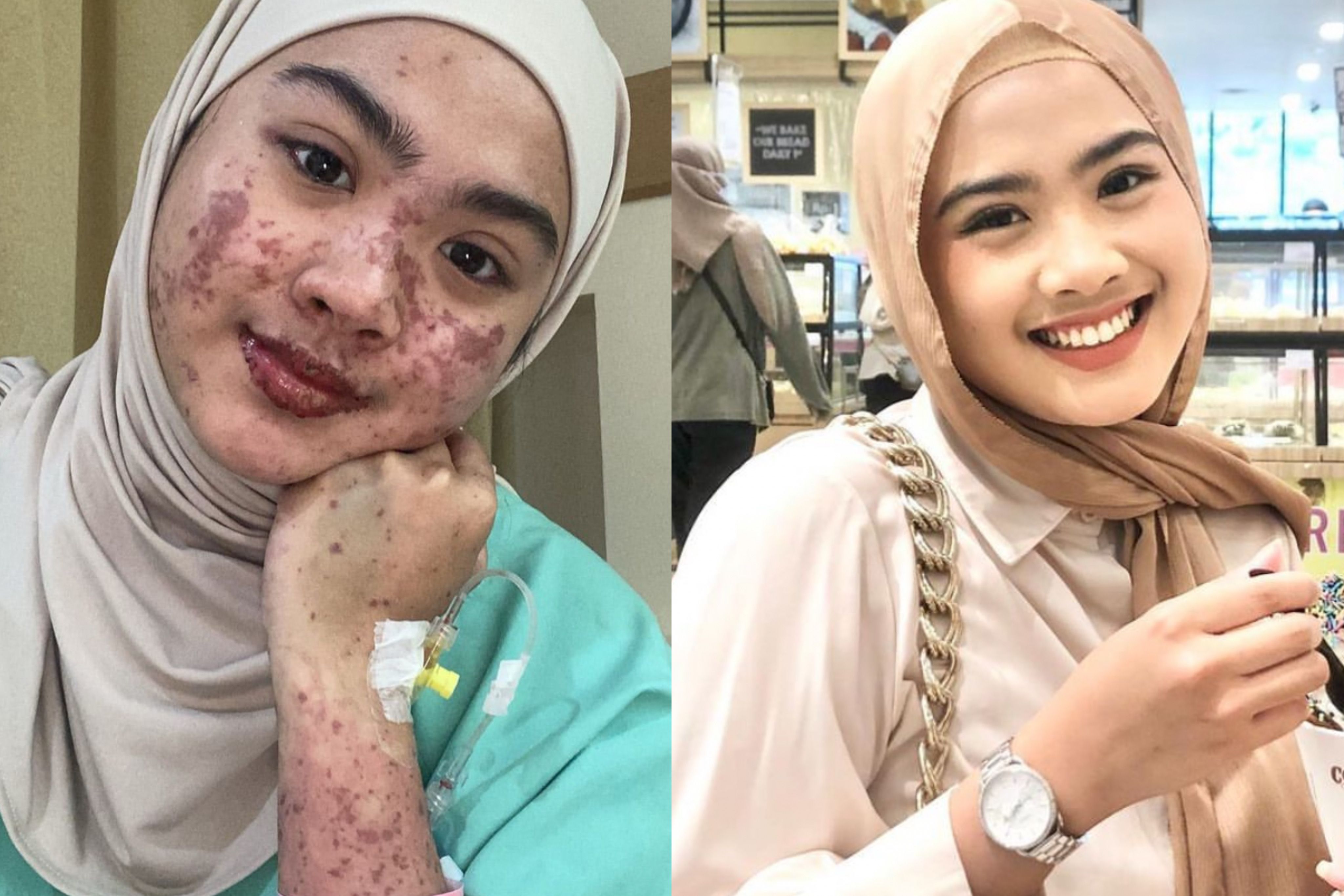 Afina Syifa menceritakan pengalamannya saat terkena Steven Johnson Syndrome (SJS) pada bulan Maret lalu di Podcast Cerita Parapuan.