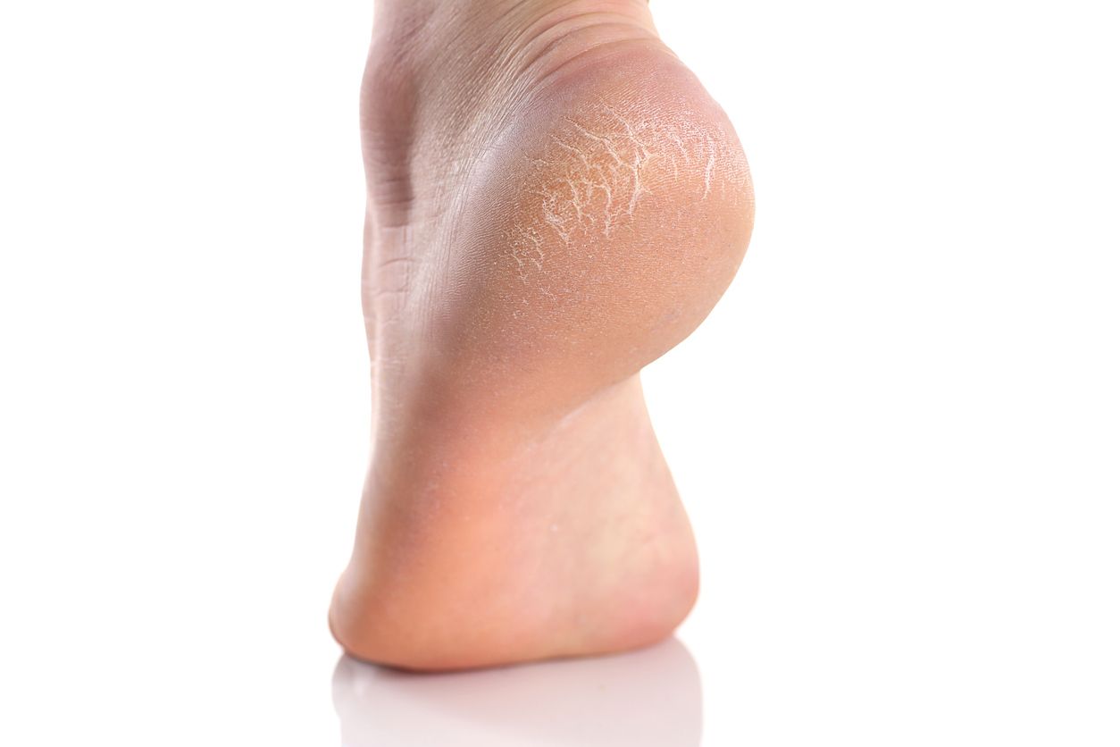 Tumit pecah-pecah bisa buat kepercayaan diri menurun, terutama saat pakai high heels. Ini cara mengatasinya dengan mudah di rumah.