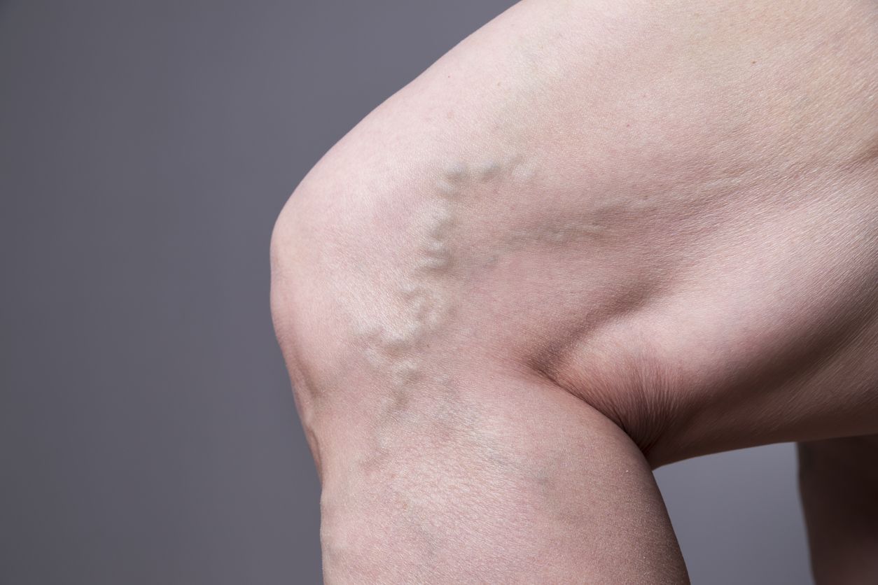 Dokter spesialis bedah jelaskan penyebab perempuan mengalami varises yang tidak hanya di kaki tapi juga vagina. Simak penyebab varises vagina.